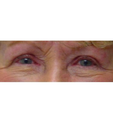 Facial Rejuvenation Procedures After